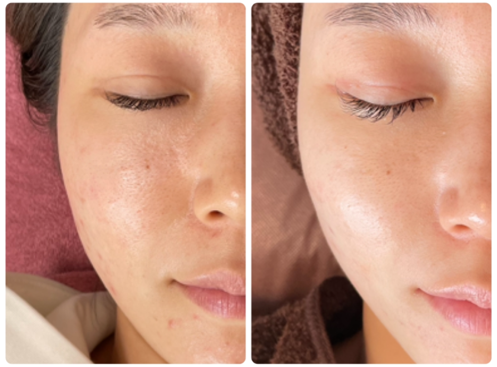 herbal peeling treatment